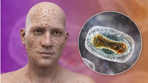 3D-Illustration einer Infektion mit Pockenviren (Orthopox variolae). Foto: Imago/Science Photo Library