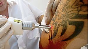 Mit einem Laser werden Farbstoffpartikel in der Haut zerschossen. So wird ein Tattoo in mehreren Behandlungen entfernt. Foto: dpa