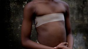 Mit der Praktik des „Brustbügelns“ soll in mehreren afrikanischen Ländern verhindert werden, dass sich die Brüste junger Mädchen normal entwickeln. Foto: Renata