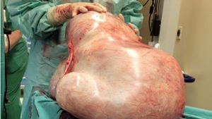 Ein 32 Kilogramm schwerer Tumor. der einer jungen Frau entfernt wurde, liegt in einem Raum der Universitätsklinik. Foto: dpa