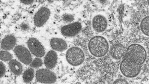 Diese elektronenmikroskopische Aufnahme aus dem Jahr 2003 zeigt reife, ovale Affenpockenviren (l) und kugelförmige unreife Virionen (r), die aus einer menschlichen Hautprobe von 2003 stammt. (Archivbild) Foto: dpa/Cynthia S. Goldsmith